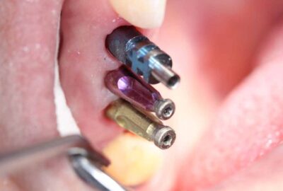 dental-implants-01b
