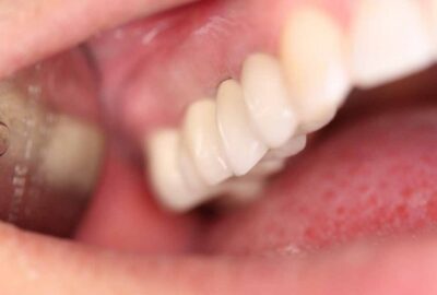dental-implants-01e