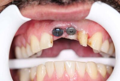 dental-implants-02c