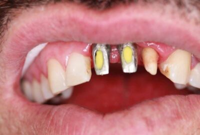 dental-implants-02d