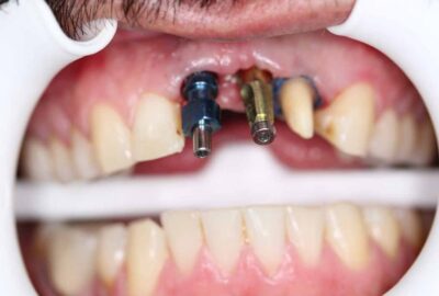 dental-implants-02e